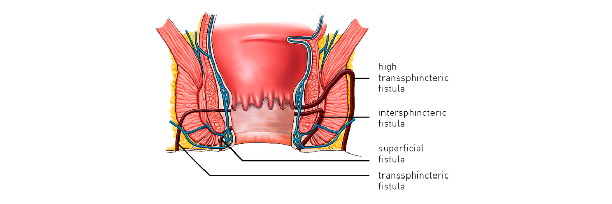 Hemorrhoids Awareness