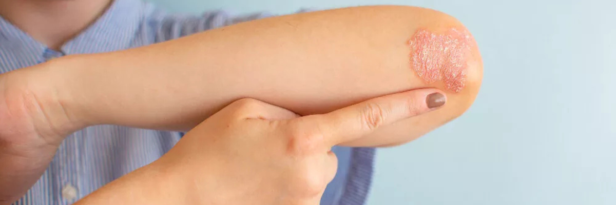 Psoriasis Ayurveda
